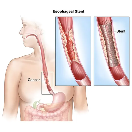 esophageal cancer package test
